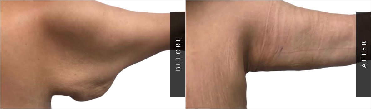 Arm Lipo Surgery Before-After
