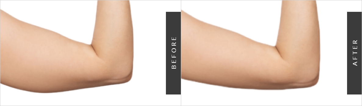 Arm Lipo Procedure Before-After