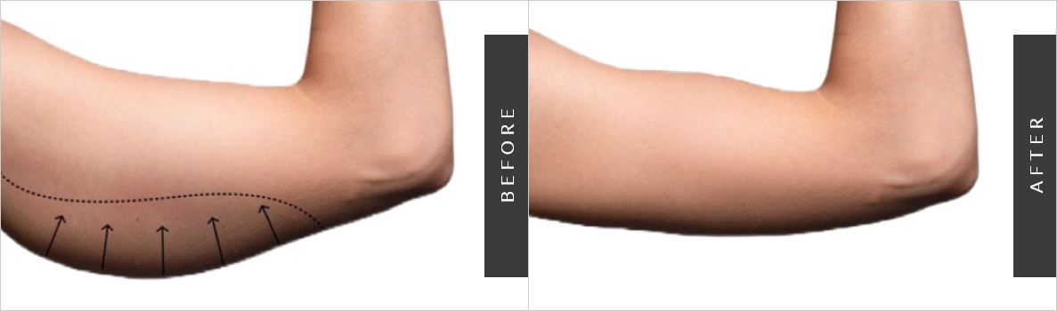 Arm Liposuction Surgery Before-After