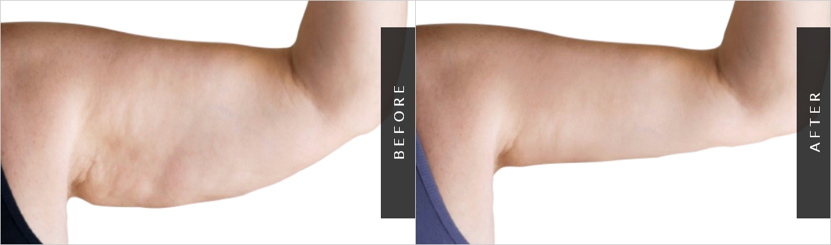 Liposuction - Arms / Axillary Before and After Pictures Case 48