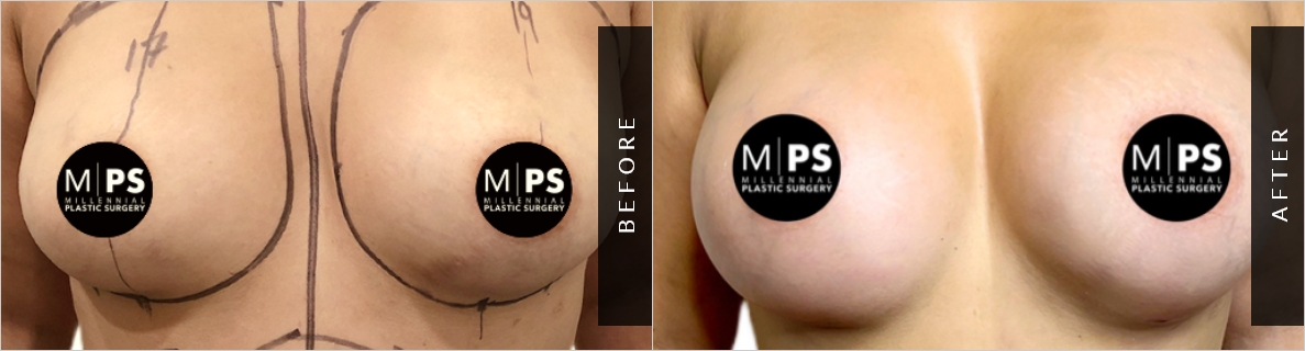 Saline vs Silicone Implants Before After