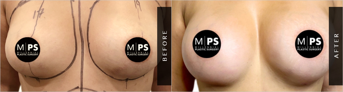 Breast Augmentation Before and After