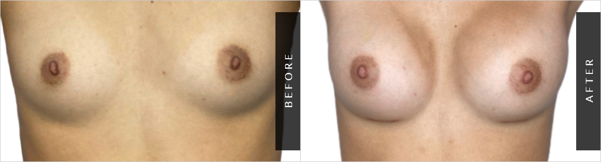Breast Enhancement Before-After