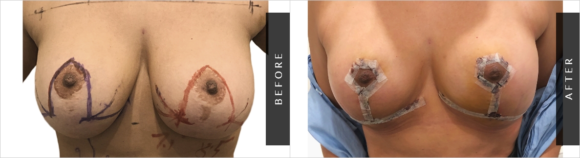 Breast Cosmetic Surgery Before & After