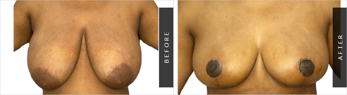 Breast Fat Transfer Surgery Before-After