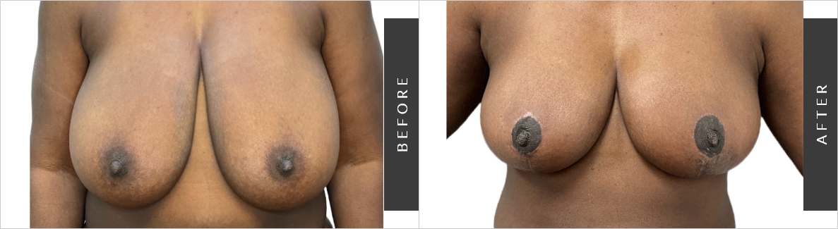 Breast Cosmetic Surgery Before/After