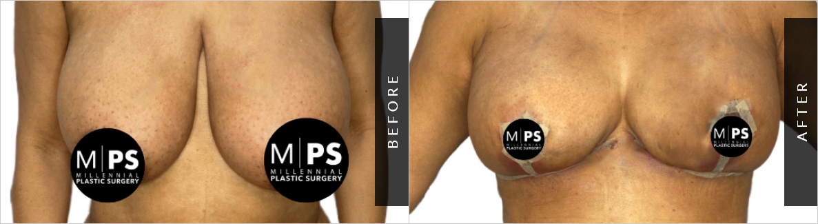 Breast Fat Transfer Procedure Before-After