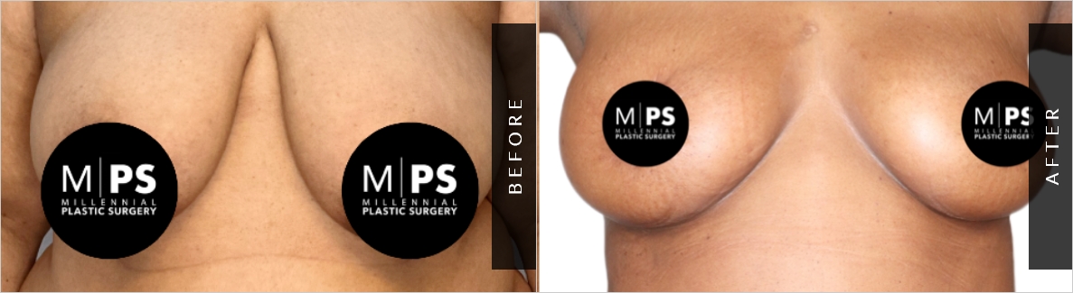 Breast Cosmetic Procedure Before & After