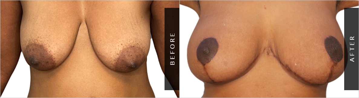 Teardrop Breast Implants Before and After