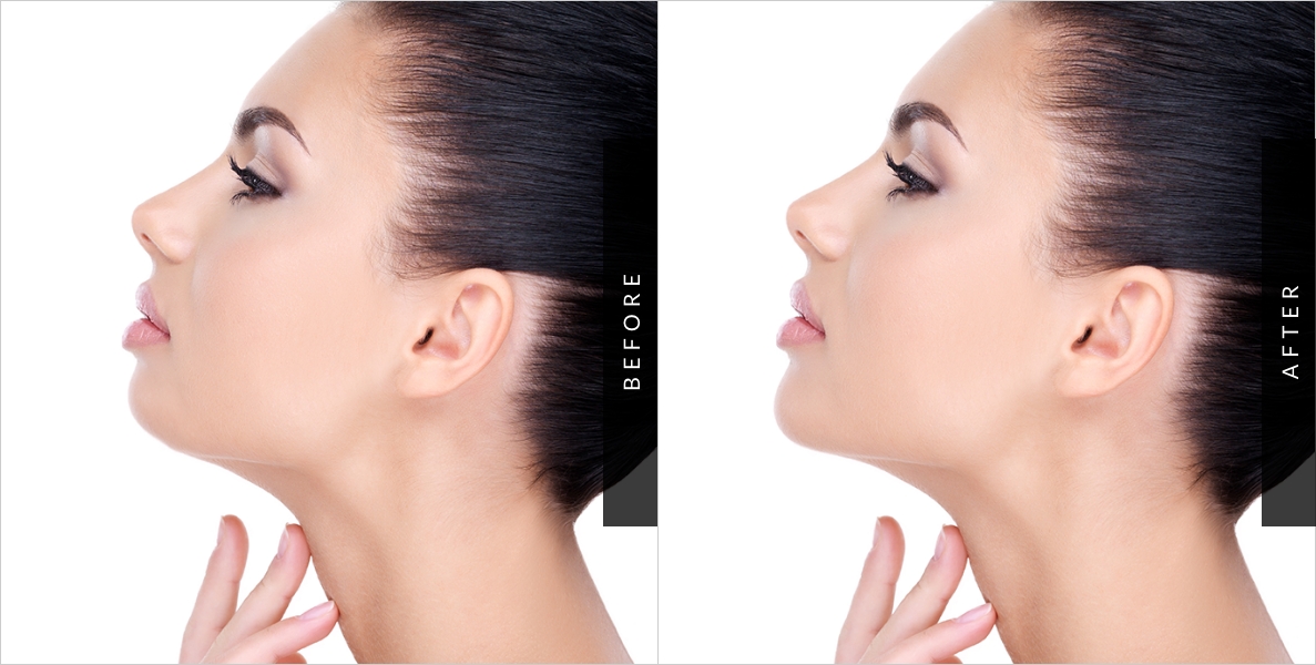 Chin Augmentation Surgery Before & After