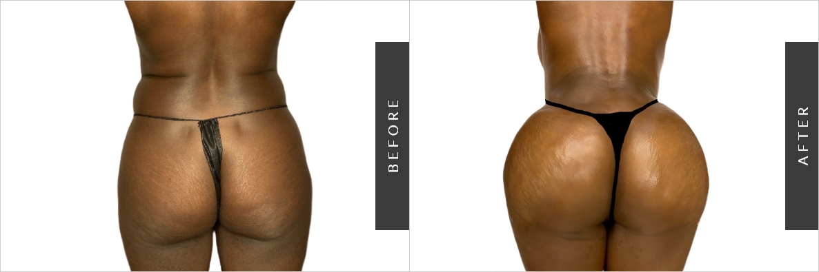 Flank Liposuction Before-After