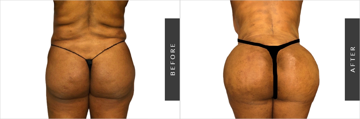 Will Lower Back Liposuction Also Address The Flanks?