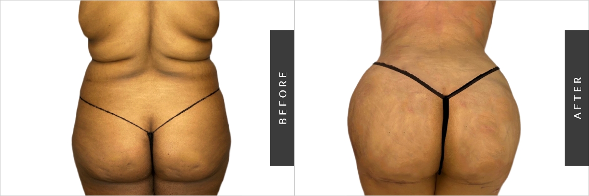 Flanks Liposuction  Before and After Photos - Palm Clinic