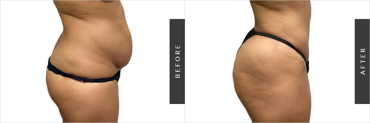 Liposuction Cost Before-After