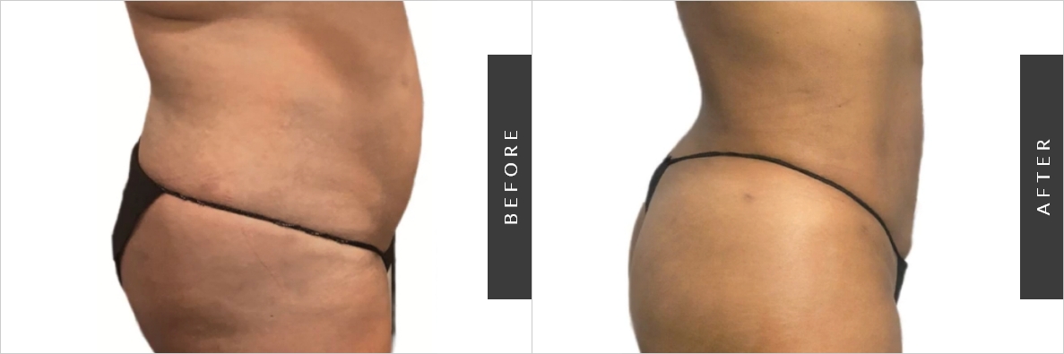 Liposuction Price Before-After
