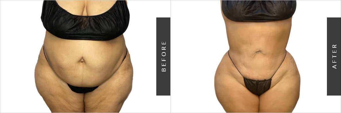 Stomach Liposuction in NYC