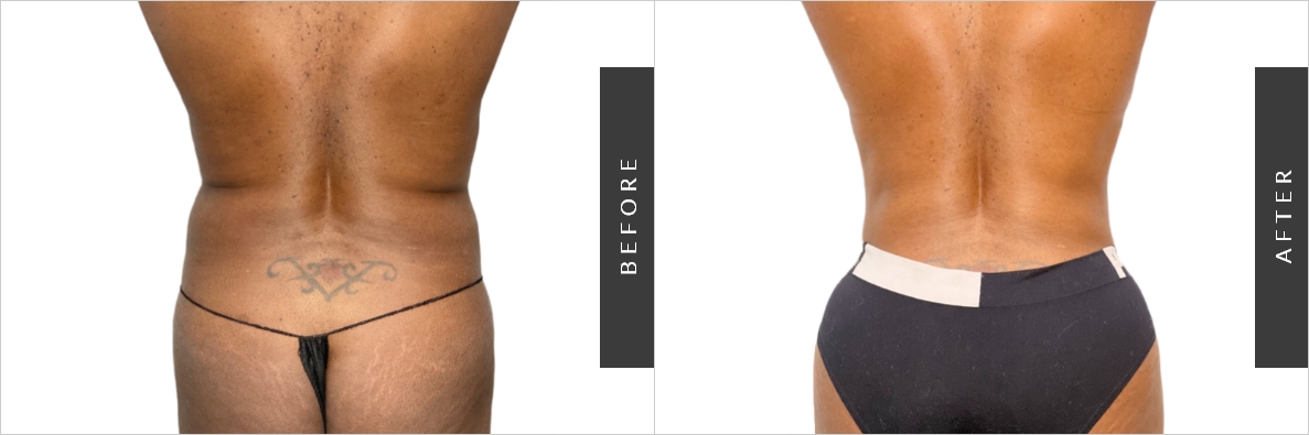 Lipo Price Before & After