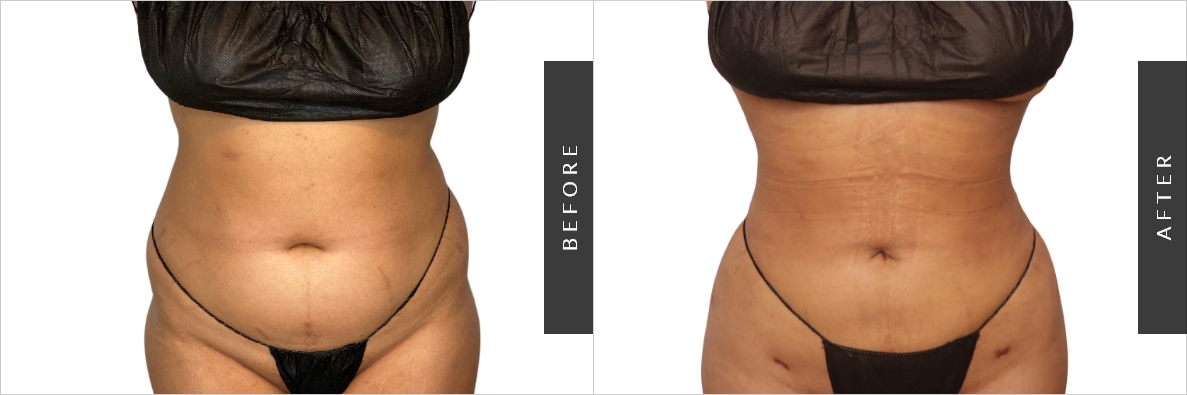 Lipo Cost Before-After