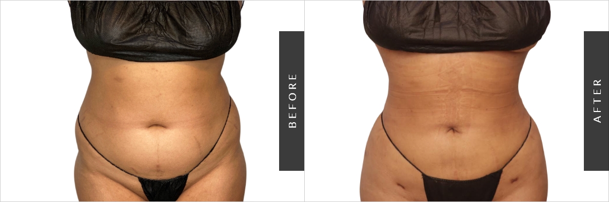 Stomach Liposuction in NYC