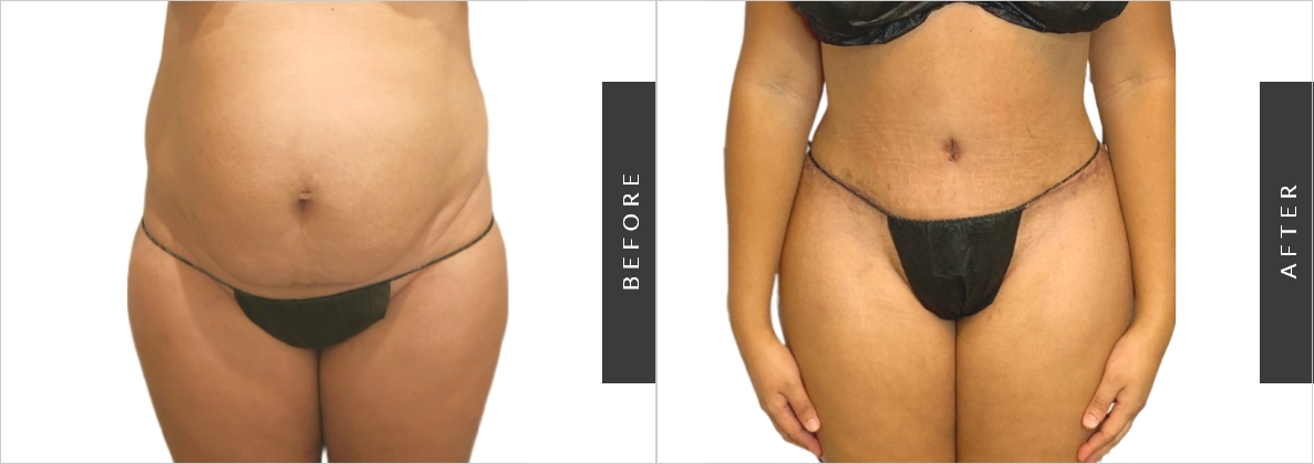 Liposuction of the FUPA (Mons)