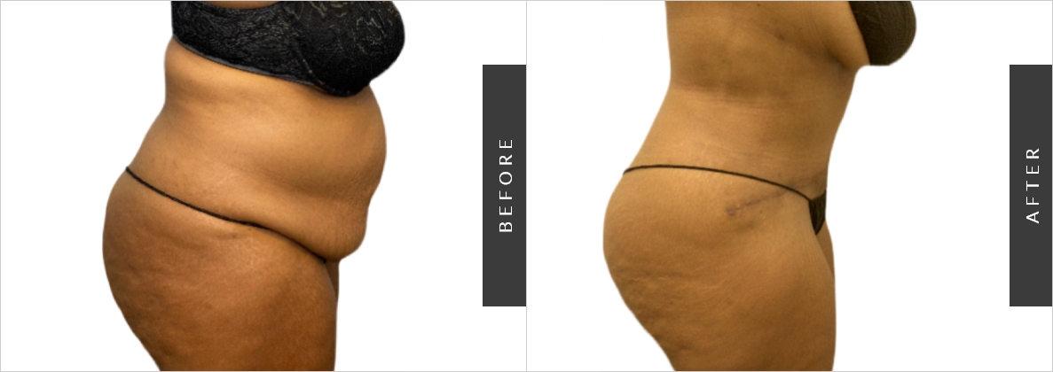 Tummy Tuck Extended Before-After