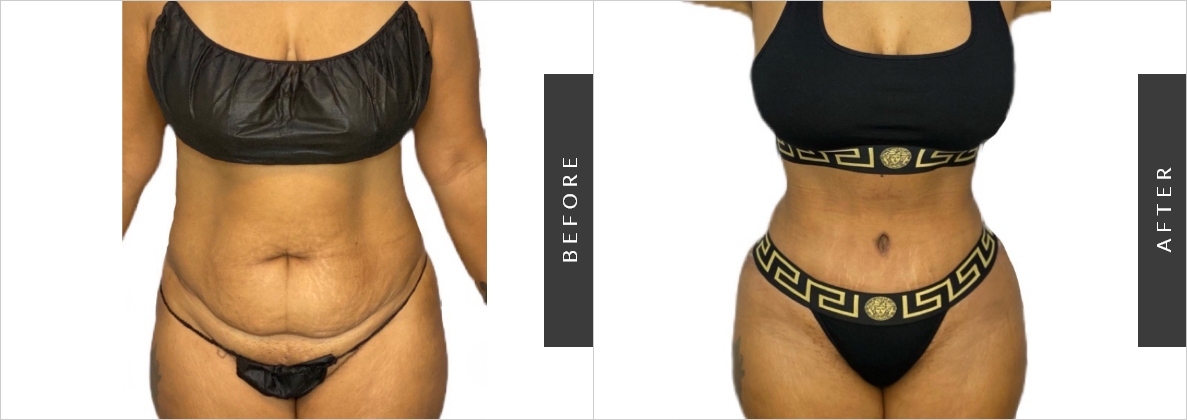Extended Tummy Tuck Surgery Before-After