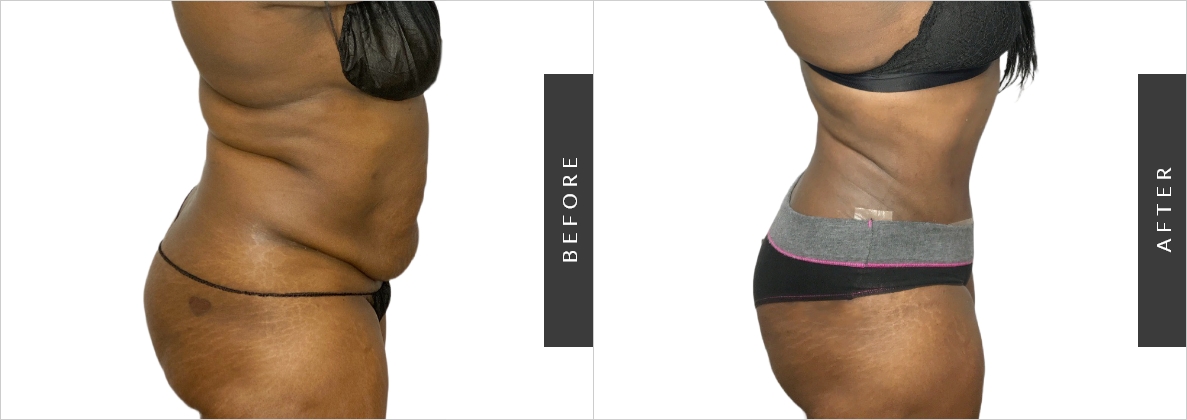 How To Get Rid Of Hip Dips - Contour Your Hips