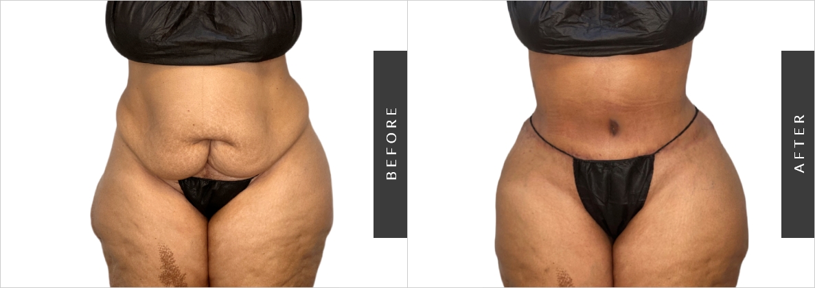 Extended Abdominoplasty Before-After