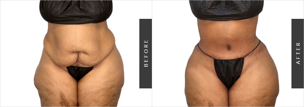 Lower Body Lift Before & After Patient 78, NYC