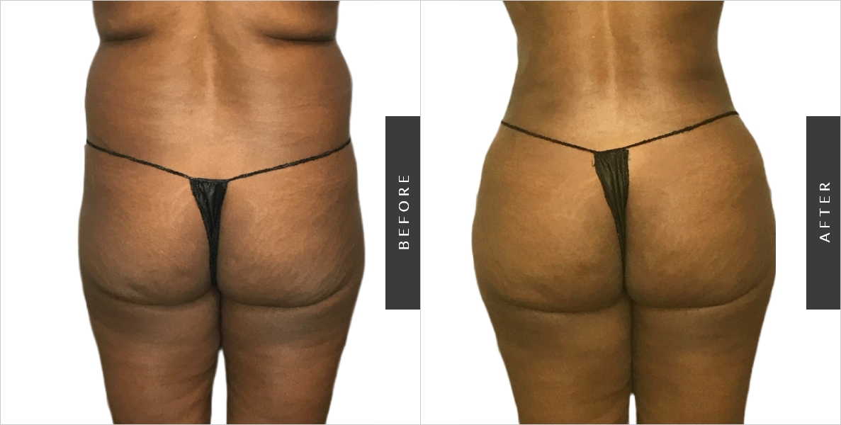 Upper Back Liposuction Before-After