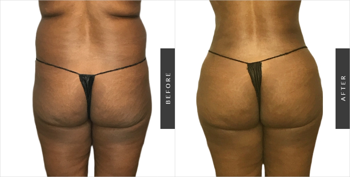 Back Contouring with Liposuction