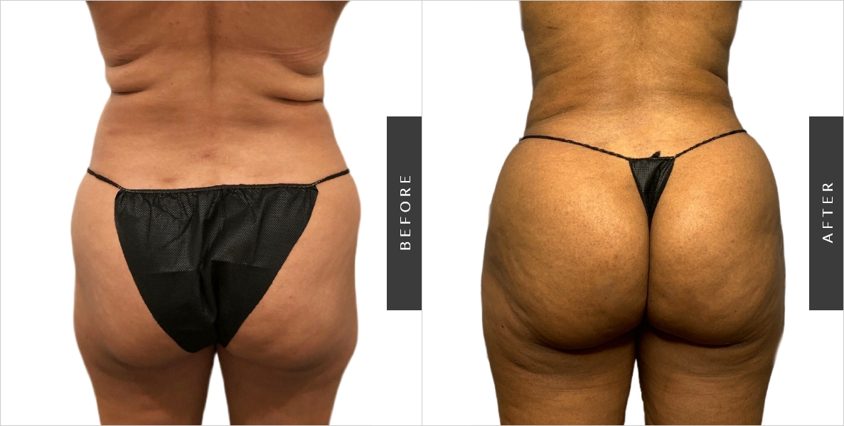 Liposuction of Back Before-After