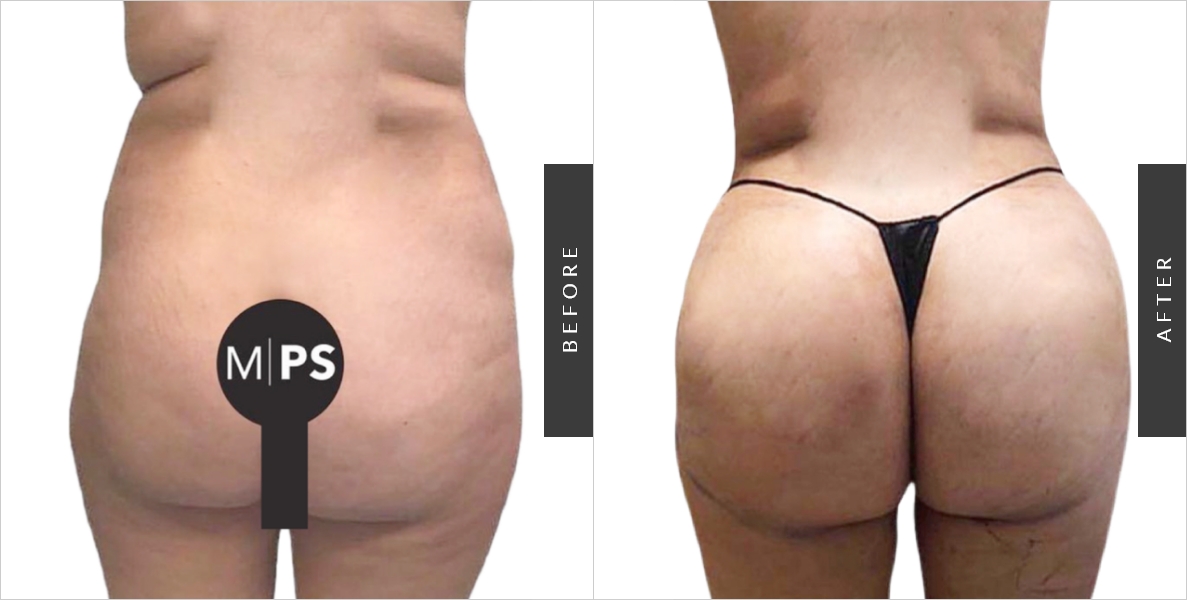 Hip Liposuction Before-After Surgery