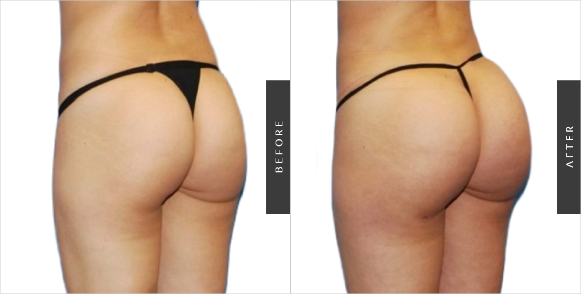 Brazilian Butt Augmentation Before-After