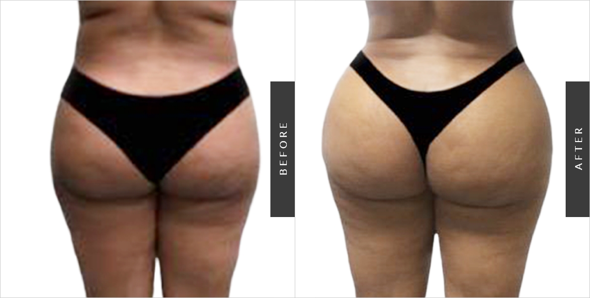 Waist Liposuction Before & After