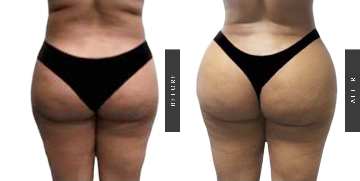 The Famous Butt Lift - Visage Cosmetic Plastic Surgery