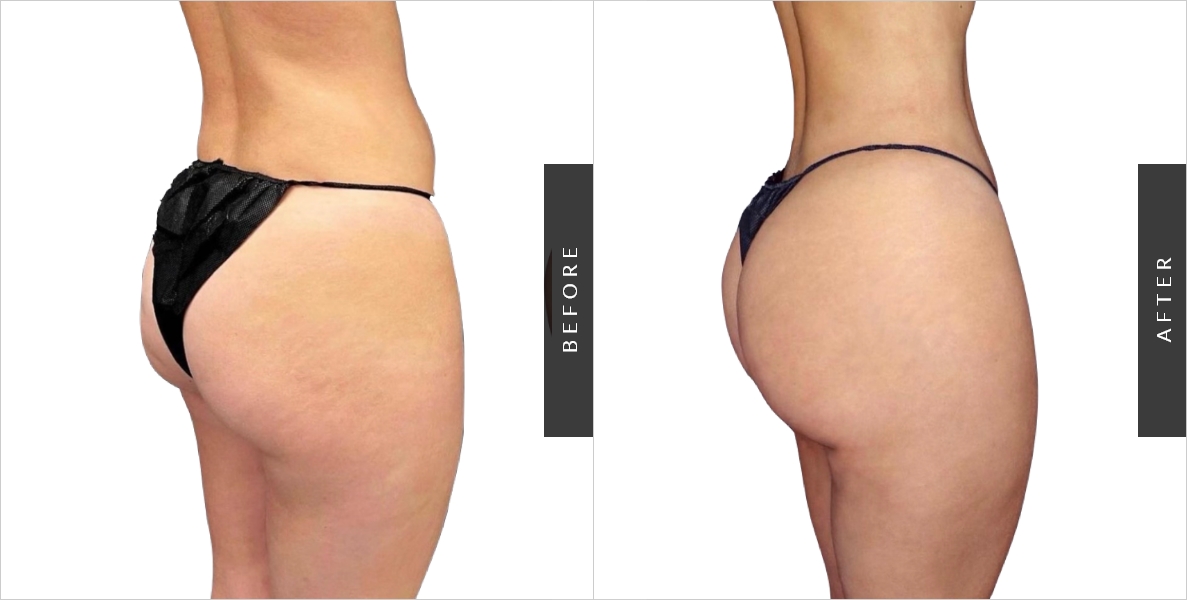 Butt Lift Surgery Before and After Patient 02