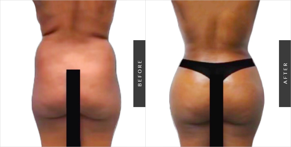 Butt Implants Before-After