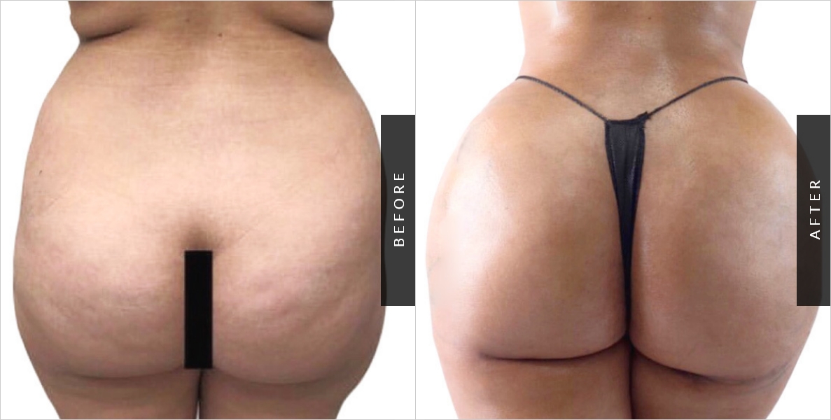 Brazilian Buttock Augmentation Before-After