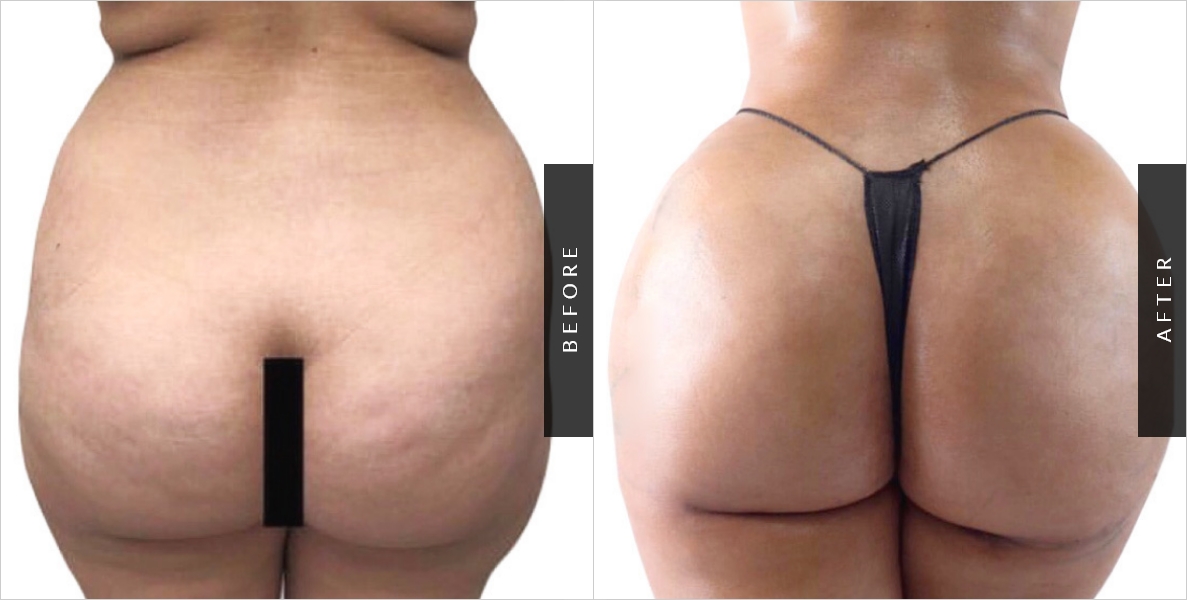 Butt Implants NYC - Butt Augmentation Surgeon Manhattan & Bronx