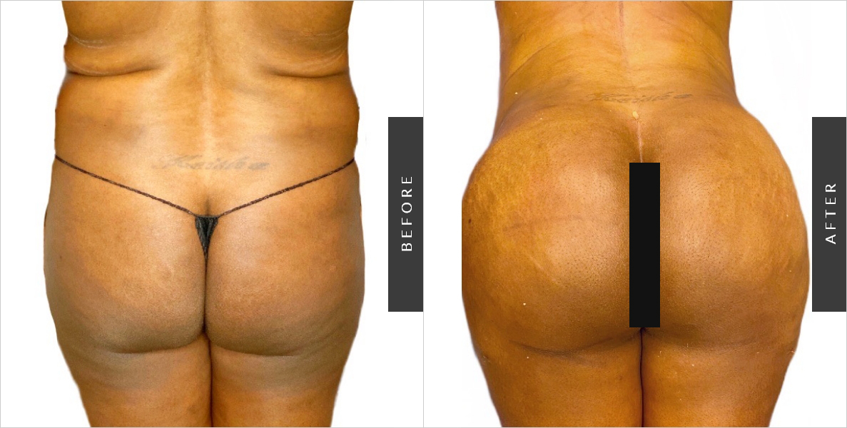 Back Lipo Before-After
