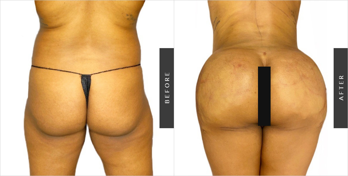 Butt Enlargement Surgery Before-After