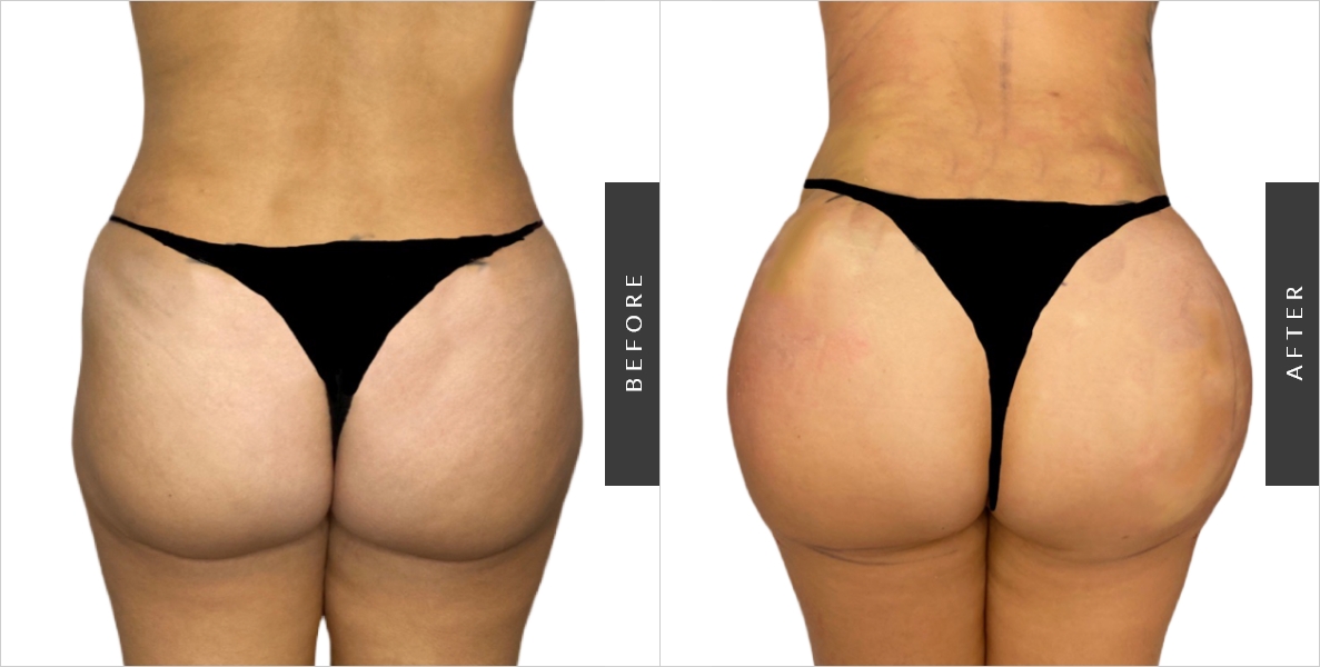 Buttocks Reduction Surgery Before - After