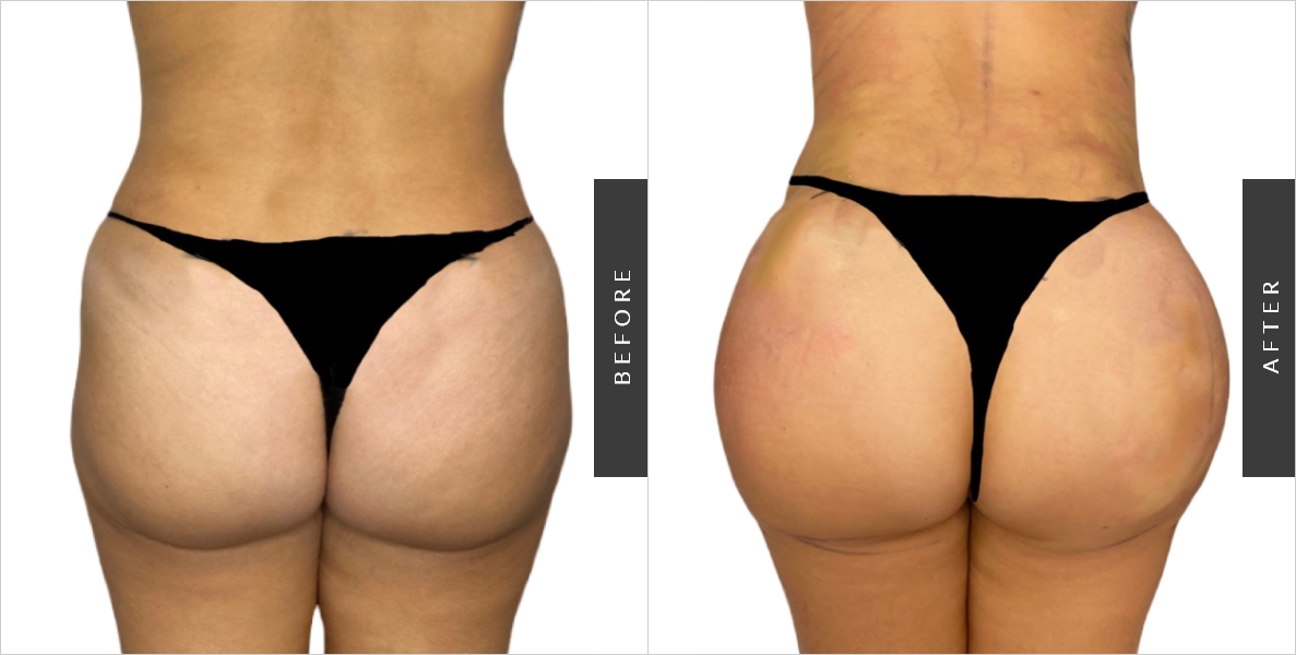 Liposuction with Buttock Augmentation Gives You an Hourglass