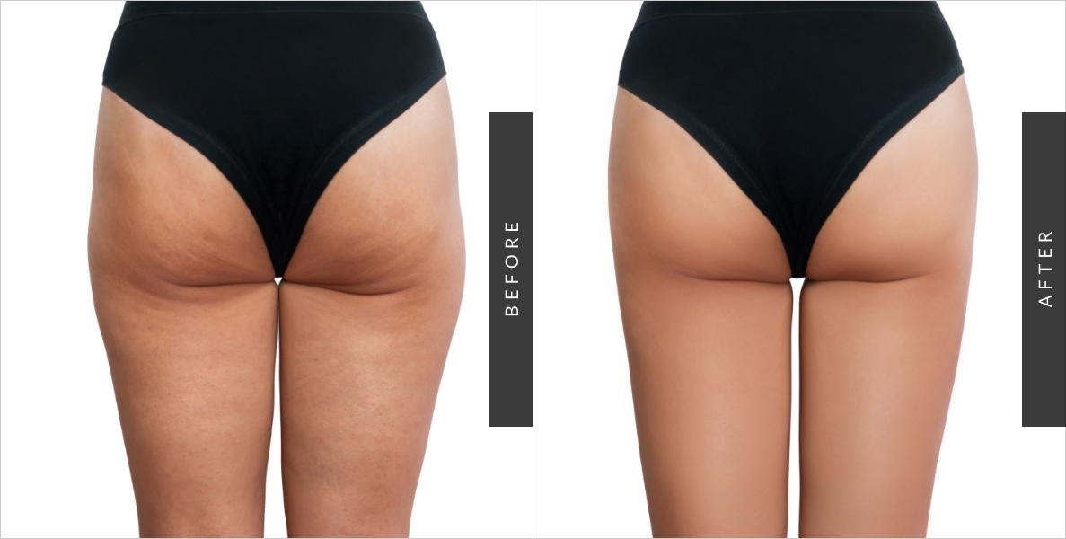 Hip Augmentation Before-After
