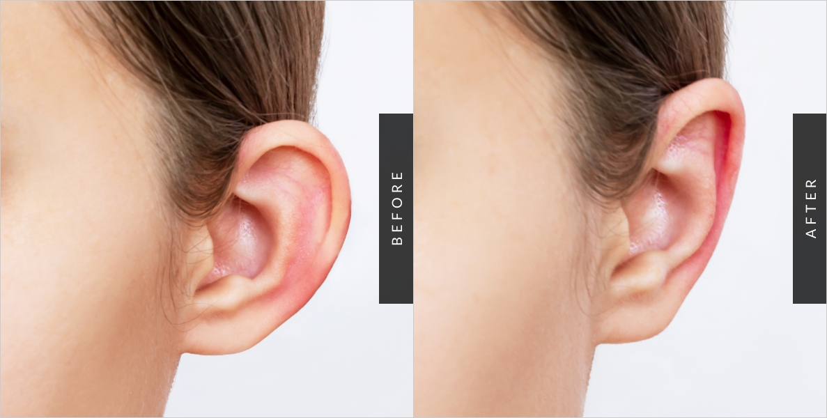 Ear Surgery Before-After