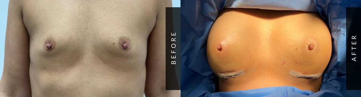 Breast Augmentation Before-After