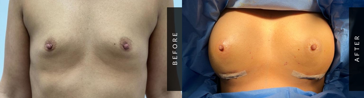 Breast Augmentation Before and After