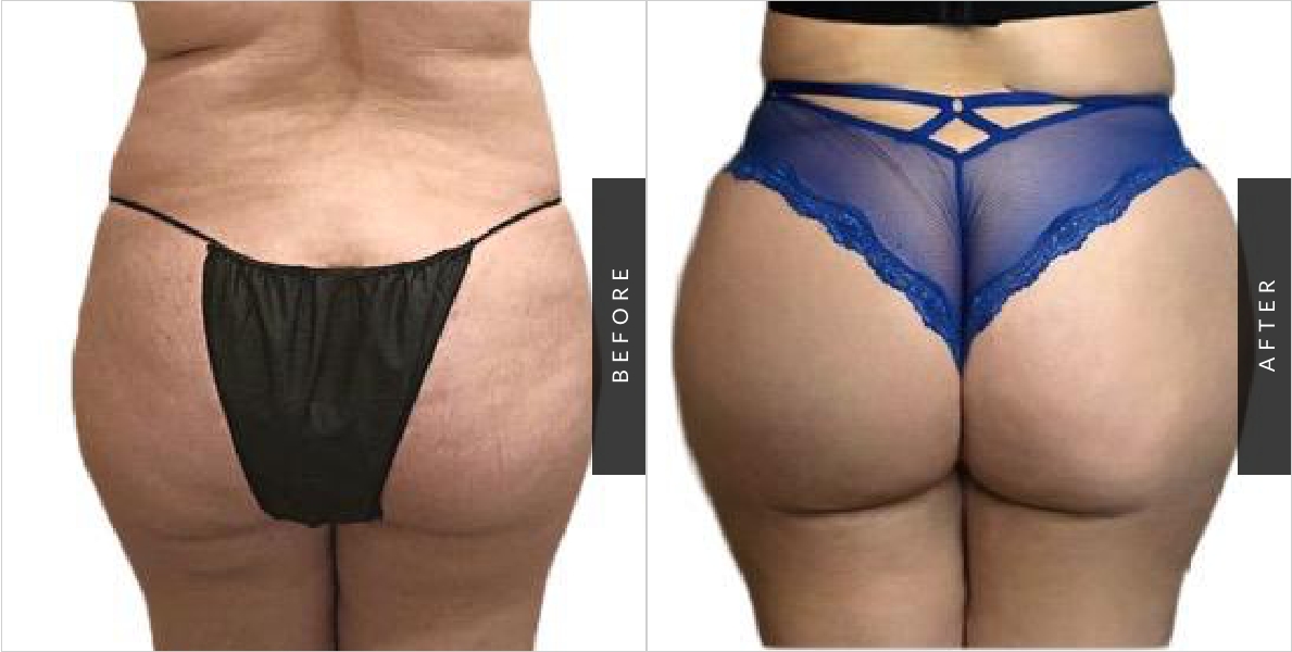 Brazilian Butt Lift Before-After