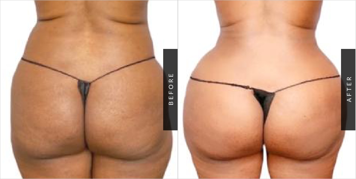 Body Lift Plastic Surgery Before/After